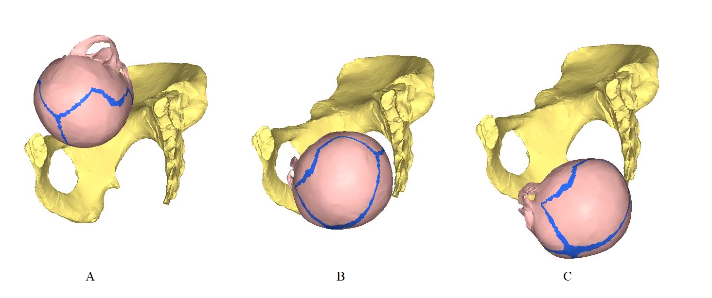 Les différentes étapes de l’accouchement de Lucy avec un fœtus à petit crâne (110g) modélisées par l’analyse en élément-fini : A engagement, B descente, C dégagement. - Crédit : © Pierre Frémondière